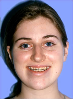 Patient 112 - Side View