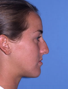 Patient 114 - Side View