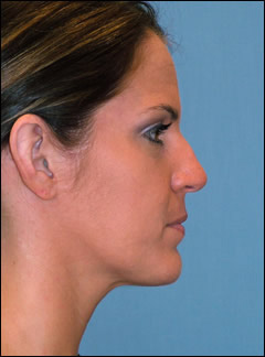Patient 116 - Side View