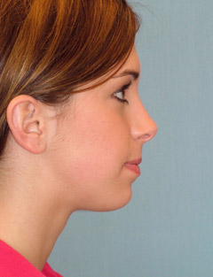 Patient 122 - Side View