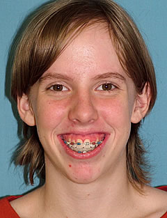 Patient 123 - Front View