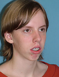 Patient 123 - Side View