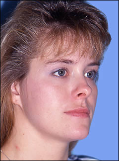 Patient 212 - Front View