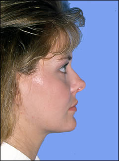 Patient 212 - Side View