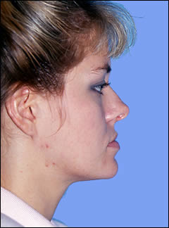 Patient 212 - Side View