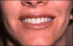 Patient 221 - Front View