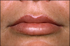 Patient 222 - Front View