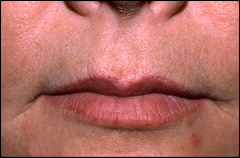 Patient 222 - Front View