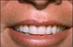 Patient 222 - Front View