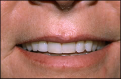 Patient 222 - Front View