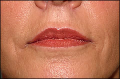 Patient 223 - Front View