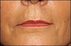 Patient 223 - Front View