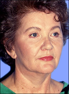 Patient 241 - Front View