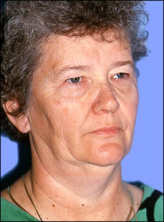 Patient 241 - Front View