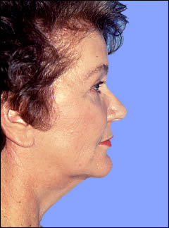 Patient 241 - Front View