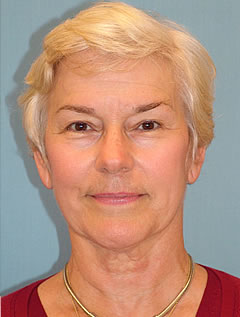 Patient 245 - Front View