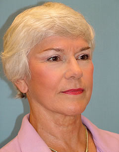 Patient 245 - Front View