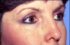 Patient 252 - Side View