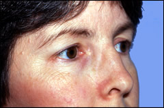 Patient 252 - Side View