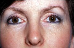 Patient 252 - Front View