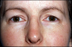 Patient 252 - Front View