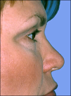 Patient 253 - Side View