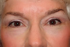 Patient 255 - Front View