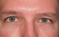 Patient 256 - Front View