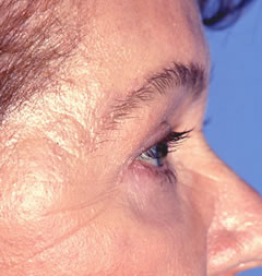 Patient 257 - Side View