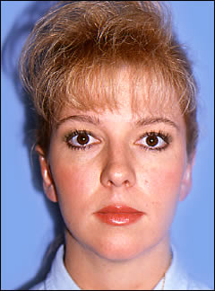 Patient 282 - Front View