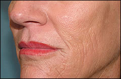 Patient 401 - Side View Before