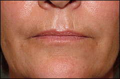 Patient 402 - Front View Before