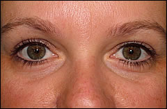 Patient 404 - Front View Before
