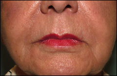 Patient 404 - Front View After
