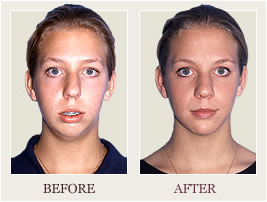 Before and After Photo of Patient #113