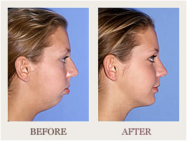 Before and After Photo of a Chin Augmentation