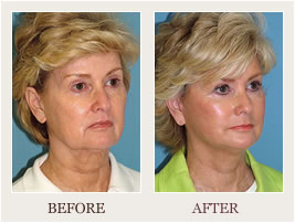 Before and After of Patient #244